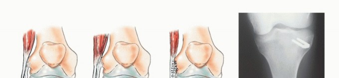 Illustration 24 for Beyond Amputation: The Type I Resection in Fibular Tumor Surgery