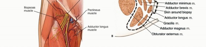 Illustration 2 for Optimizing Adductor Muscle Group Resection for Limb Preservation