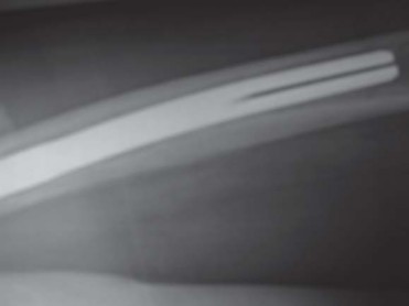 Illustration 70 for S-ROM: Inside the Technique of Modular Implant Design