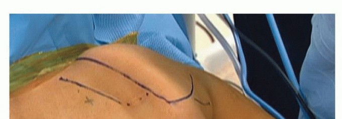 Illustration 12 for Is Your Dorsal Scapular Nerve Causing Snapping Scapula Pain?