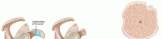 Illustration 7 for Latarjet for Instability: Bone Loss Solutions, Per Burkhart SS, Lo