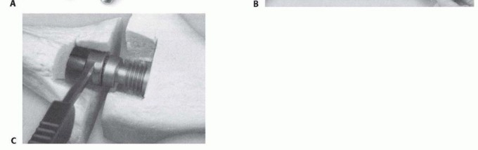 Illustration 6 for Knee Arthrodesis: A Solution for Stable Femur & Tibia Fusion
