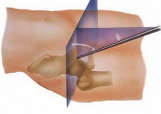 Illustration 16 for Solving Hip Soft Tissue Pathology with Advanced Arthroscopy