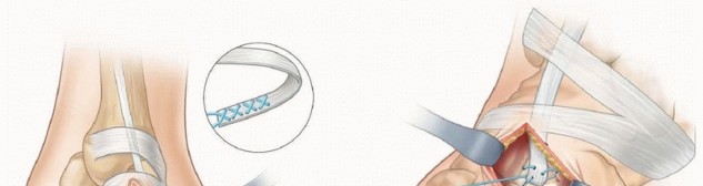 Illustration 14 for Why Anterior Tibialis Muscle Transfer Fixes Clubfoot