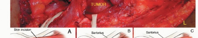 Illustration 9 for Optimizing Resection: An Overview of Surgical Approaches for Space Sarcomas