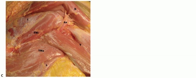 Illustration 3 for Restore Shoulder Function with Latissimus Dorsi Tendon Transfer