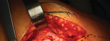 Illustration 64 for Successful Total Hip Replacement in Developmental Dysplasia