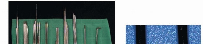 Illustration 4 for Williams Rod: Achieve Stability for Pseudarthrosis within the Tibia