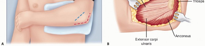 Illustration 6 for Radial Head Arthroplasty: Restoring Elbow Function & Stability