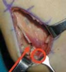 Illustration 9 for Unlocking Mobility: Distal Lengthening for Lateral Hamstring Muscle