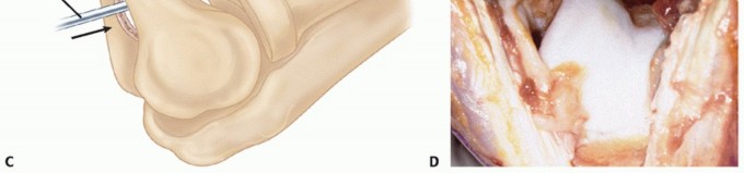 Elbow Pain Relief: Ulnohumeral Outerbridge-Kashiwagi Arthroplasty