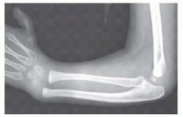Expert Guide to Reconstruction Radial Dysplasia: Improving Outcomes
