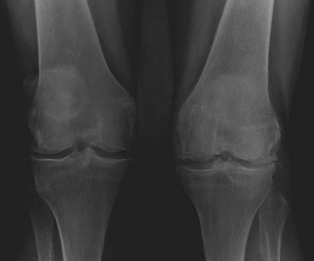 Illustration 2 for Optimizing TKR in Valgus: Expert Strategies for Complex Cases