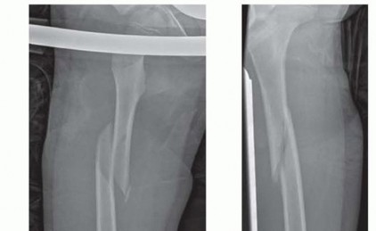 Flexible Intramedullary Nailing: Optimizing Pediatric Femur Fracture Care