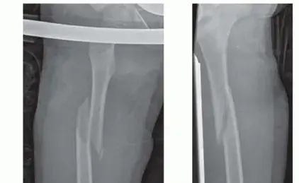 كسور عظم الفخذ: دليل شامل للمريض وعلاجها بالمسمار النخاعي المرن مع الأستاذ الدكتور محمد هطيف