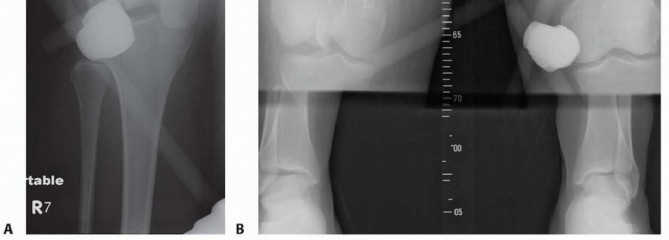 Illustration 42 for Repairing Distal Femur Fractures: Open Reduction & Internal Fixation