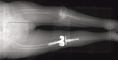 Arthrodesis with an Intramedullary Nail: Fixing Failed TKAs
