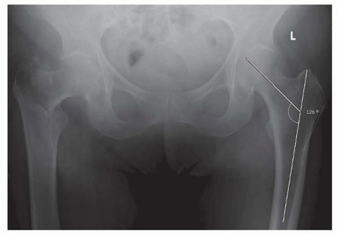 Illustration 5 for ORIF for Peritrochanteric Hip Fractures: Achieve Stable Mobility