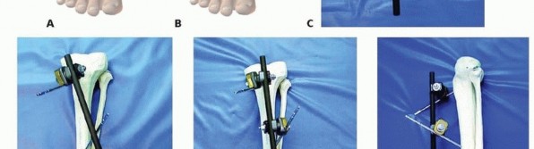 Illustration 28 for Tibia External Fixation: See How Pins Are Placed for Healing