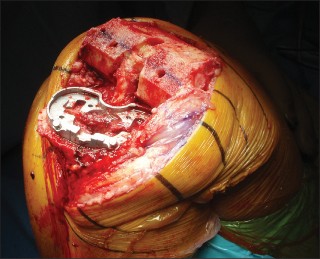 Illustration 2 for Posterior Cruciate Ligament-Retaining TKA: Navigating Pitfalls