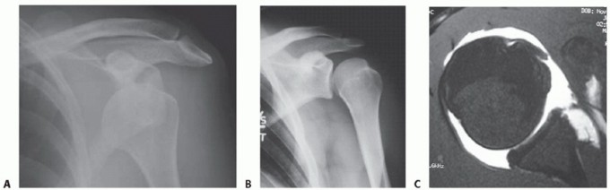 Illustration 6 for Bankart Repair & Inferior Capsular Shift: Solving Shoulder Instability