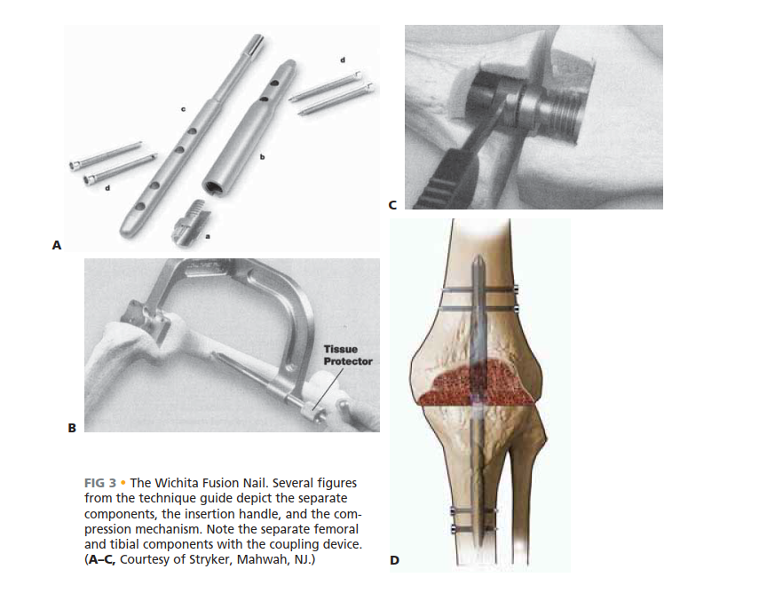 Illustration 4 for Knee Arthrodesis: A Lifelong Knee Solution for Trauma & TKA