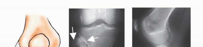 Illustration 10 for Beyond Amputation: The Type I Resection in Fibular Tumor Surgery