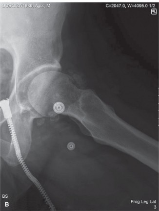 Illustration 2 for Don't Miss Synovial Chondromatosis in Orthopedics Oncology Cases
