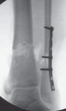 Illustration 65 for Optimal Nailing of the Tibia: Techniques for Challenging Fractures