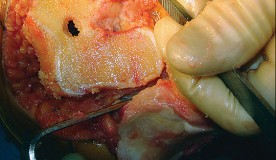 Illustration 31 for Mastering TKA: Essential Methods of Rotational Alignment