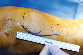 صورة طبية: جراحة استبدال مفصل الركبة الجزئي (UKA): تجنب الأخطاء والاستفادة القصوى في صنعاء مع الأستاذ الدكتور محمد هطيف