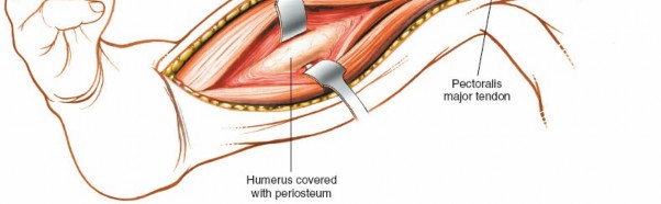 Illustration 20 for Mastering the Approach to the Distal Humerus: Safety & Skills
