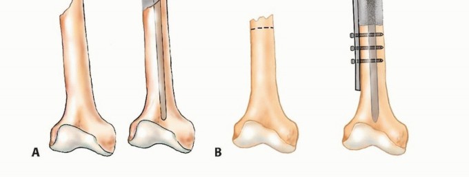 Illustration 17 for Plain Radiograph Showing MBD: Surgical Planning to Prevent Failures