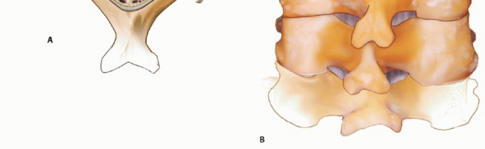 Illustration 25 for Achieve Stability: Posterior Cervical Lateral Mass Screw Fusion