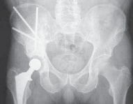 Illustration 9 for Advanced Arthroplasty for Malignant Lesions: Reclaim Your Mobility