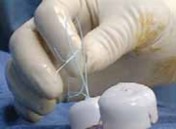 Illustration 15 for Arthroscopic Subscapularis Repair: The lo iky brady Method for Stability