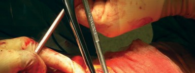 Illustration 16 for Cemented Femoral Stem Figures: Surgical Anatomy & Placement