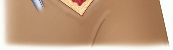 Illustration 27 for Finally Treat Recurrent Posterior Instability of the Shoulder