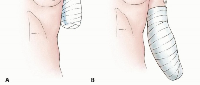 Illustration 30 for Above-Elbow & Below-Elbow Amputations: When & Why They're Needed