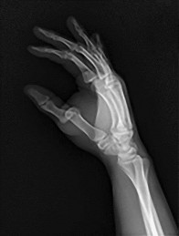 صورة طبية: دليل الأستاذ الدكتور محمد هطيف الشامل لأمراض وإصابات اليد والمعصم في صنعاء