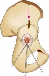 Illustration 110 for Successful Total Hip Replacement in Developmental Dysplasia