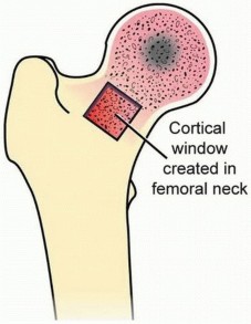 Illustration 5 for Head-Sparing for Osteonecrosis of the Femoral: Preserve Your Hip