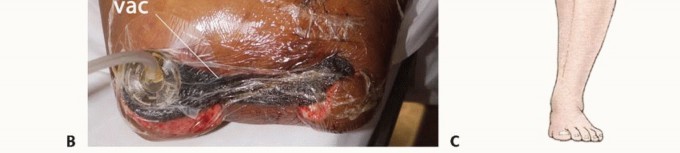 Illustration 25 for Mastering Above-Knee Amputation: Essential Surgical Insights