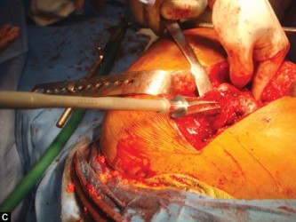 Illustration 44 for The Silent Hip: Achieving a Truly Silent, Pain-Free Joint