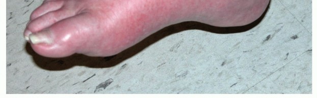 Illustration 4 for Regain Mobility: Surgical Solutions for Charcot Foot Arthropathy