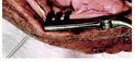 Illustration 22 for Restore Stability & Motion: Fixation of Fracture-Dislocations