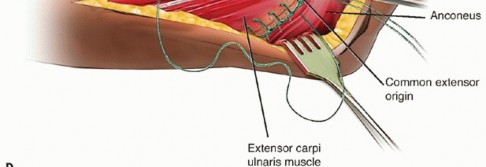 Illustration 25 for Radial Head Arthroplasty: Restoring Elbow Function & Stability