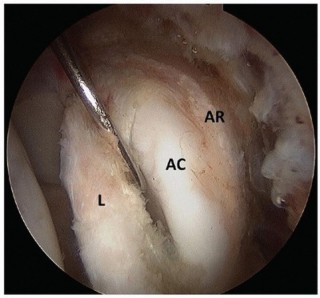 Illustration 21 for Beyond Knee Surg: Hip Arthroscopy for Sports Injuries