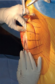 Illustration 6 for Extensor Reconstruction in Total Knee Arthroplasty: Essential Strategies