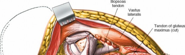 Illustration 189 for Unlocking Every Aspect of the Hip's Surgical Approaches